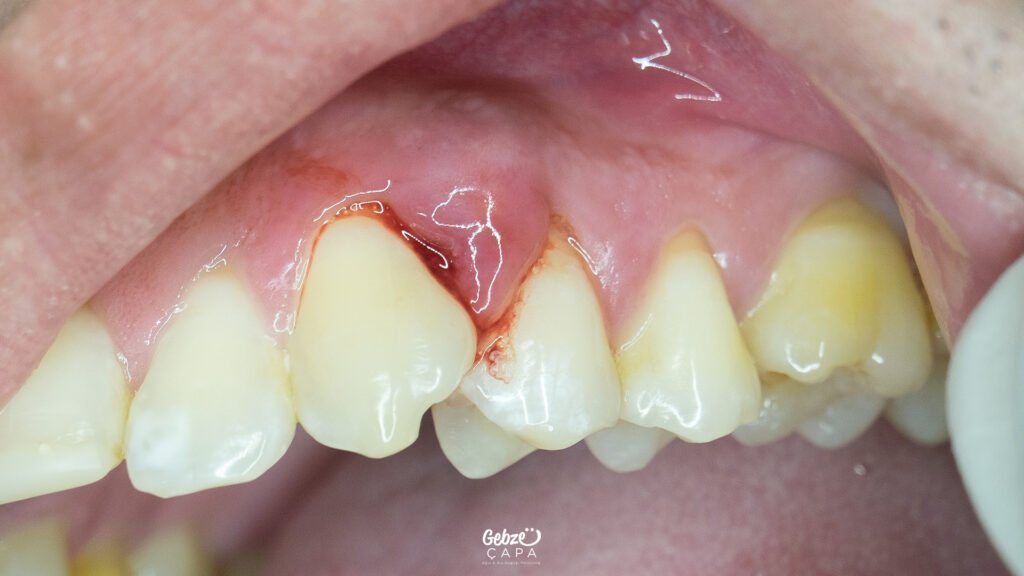 Diş Eti Hastalıkları