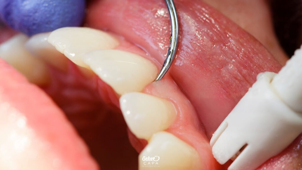 Diş Eti Hastalıkları