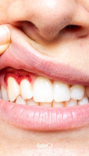 Diş Eti Hastalıkları