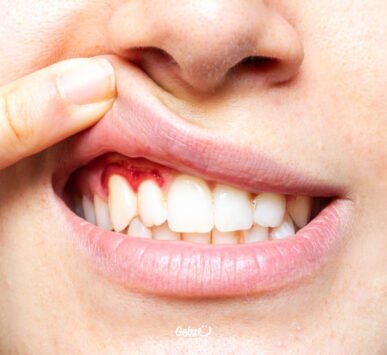 Diş Eti Hastalıkları