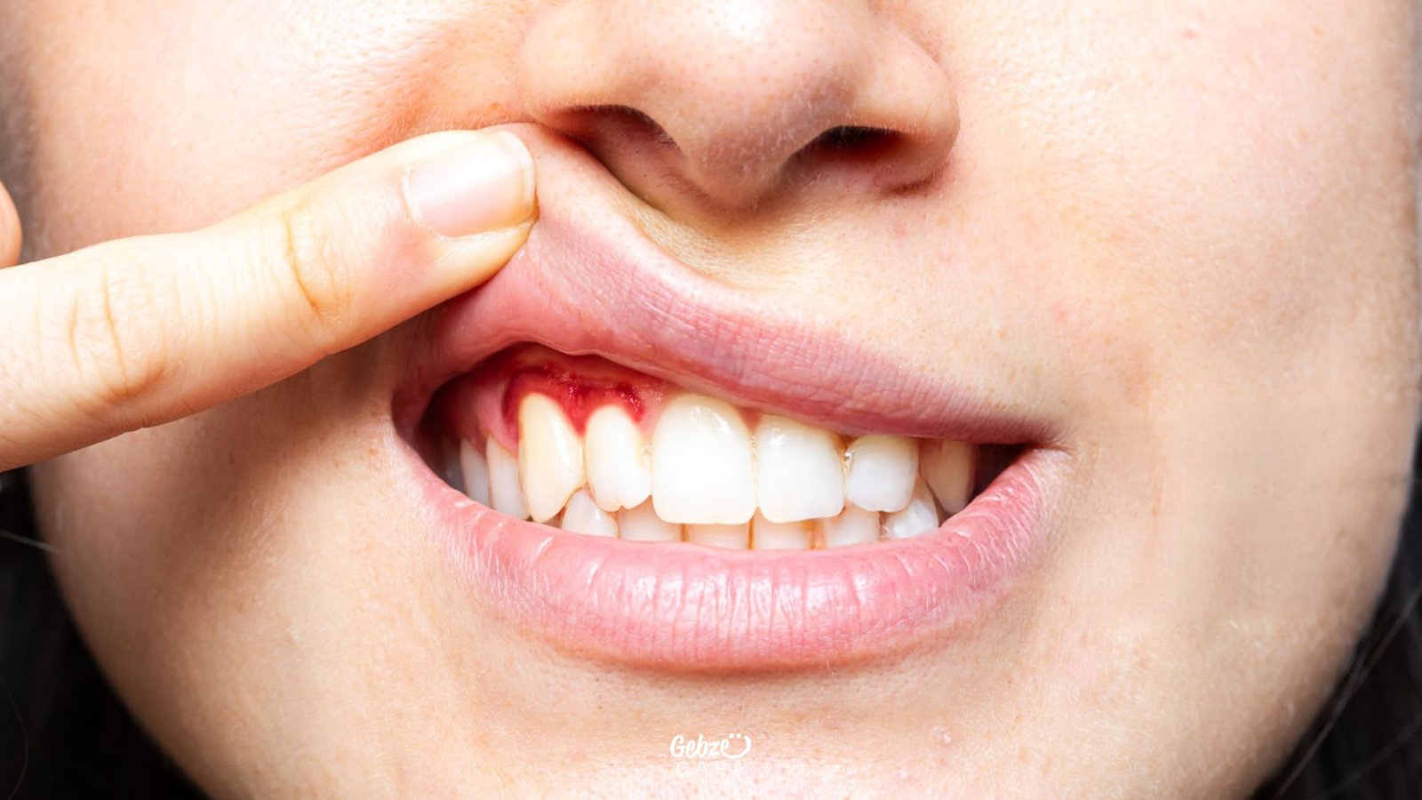 Diş Eti Hastalıkları