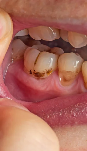 Diş Eti Hastalıkları