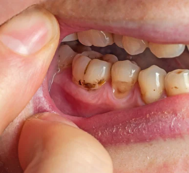 Diş Eti Hastalıkları