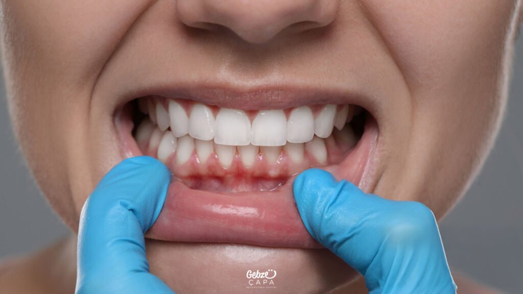 Diş Eti Hastalıkları