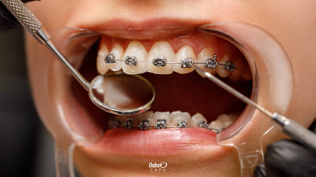 Ortodonti Tedavisi