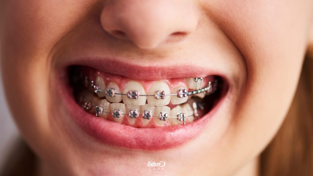 Ortodonti Tedavisi