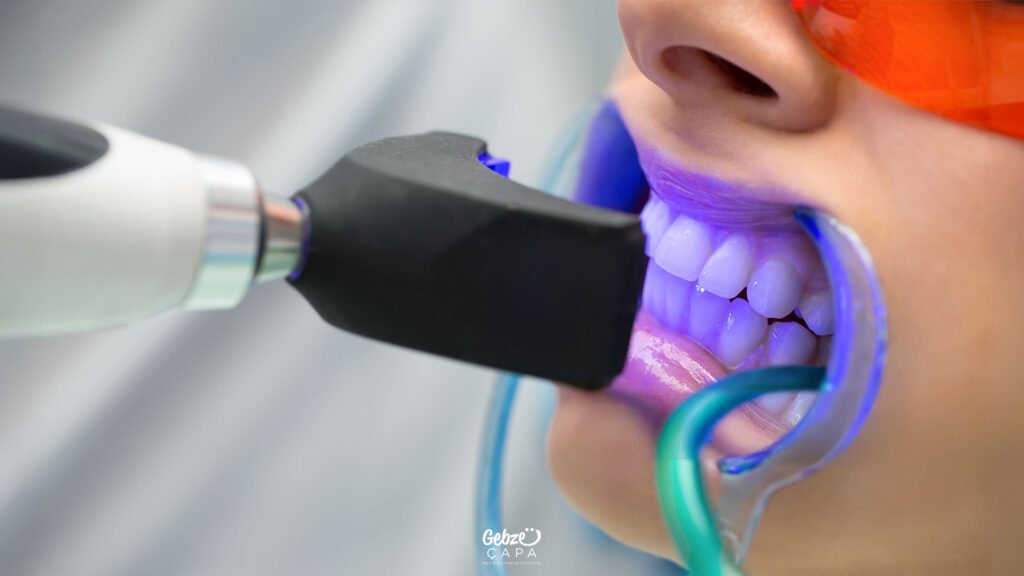 Gebze Diş Beyazlatma