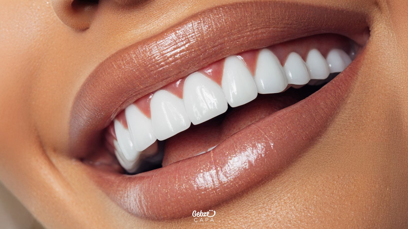 Gebze Diş Beyazlatma
