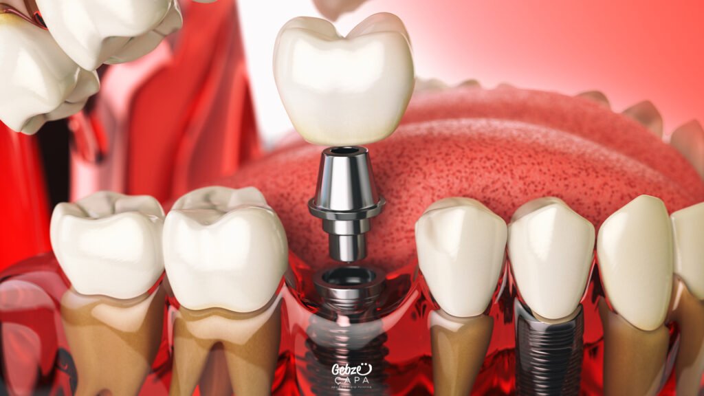 Gebze İmplant Tedavisi