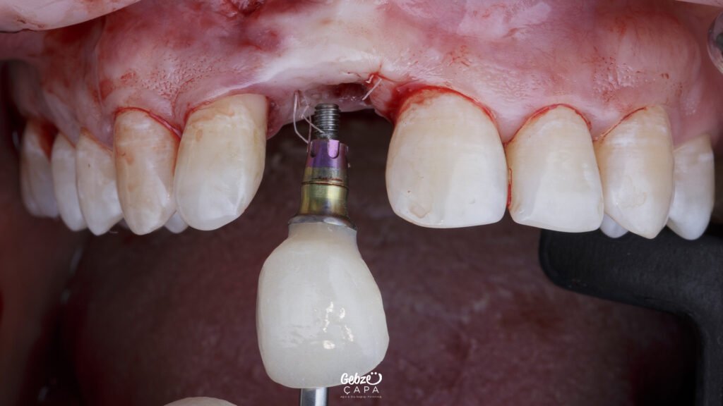 Gebze İmplant Tedavisi
