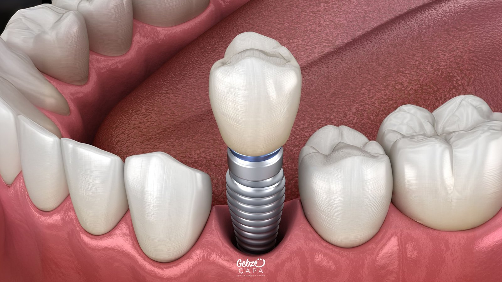 Gebze İmplant Tedavisi