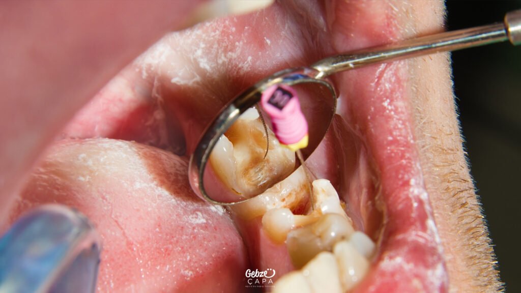 Gebze Kanal Tedavisi