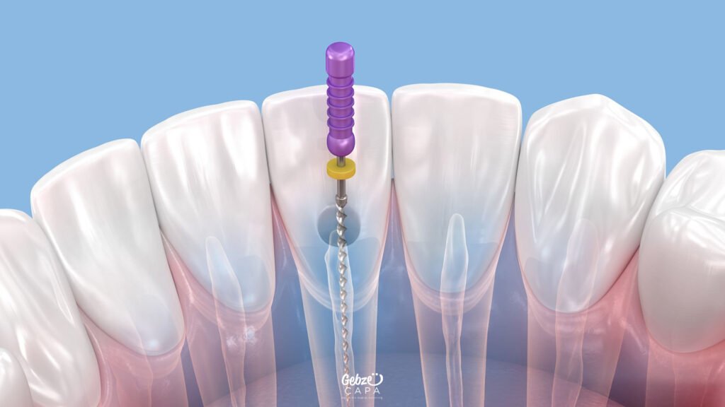 Gebze Kanal Tedavisi