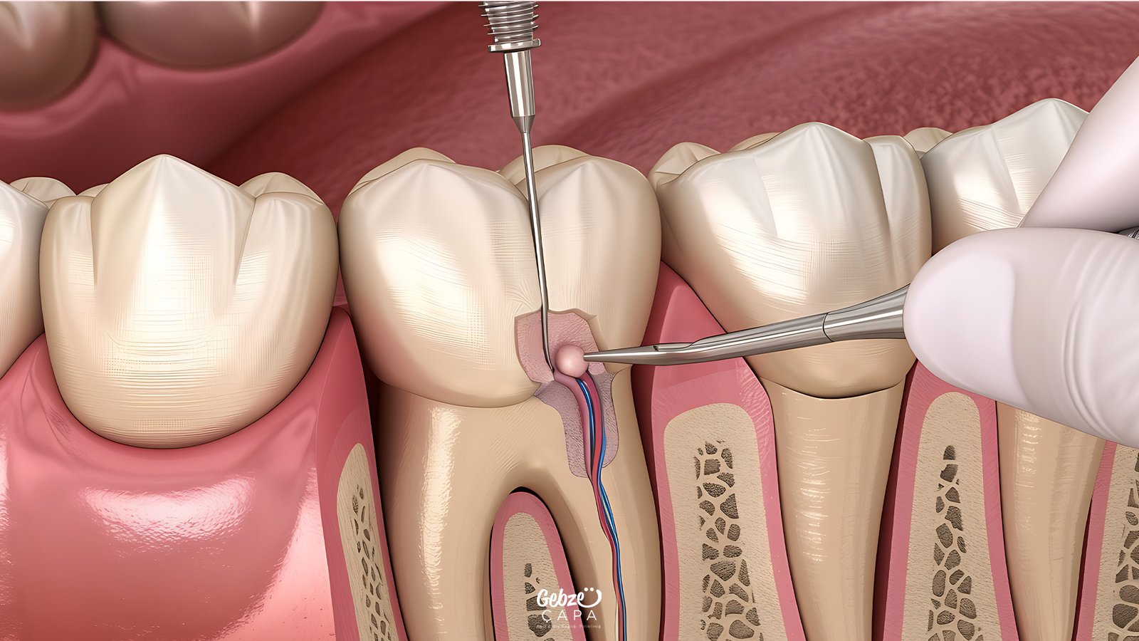 Gebze Kanal Tedavisi