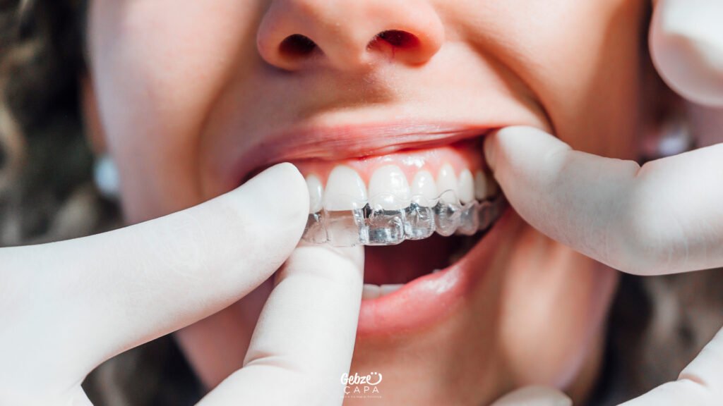 Ortodonti Tedavisi