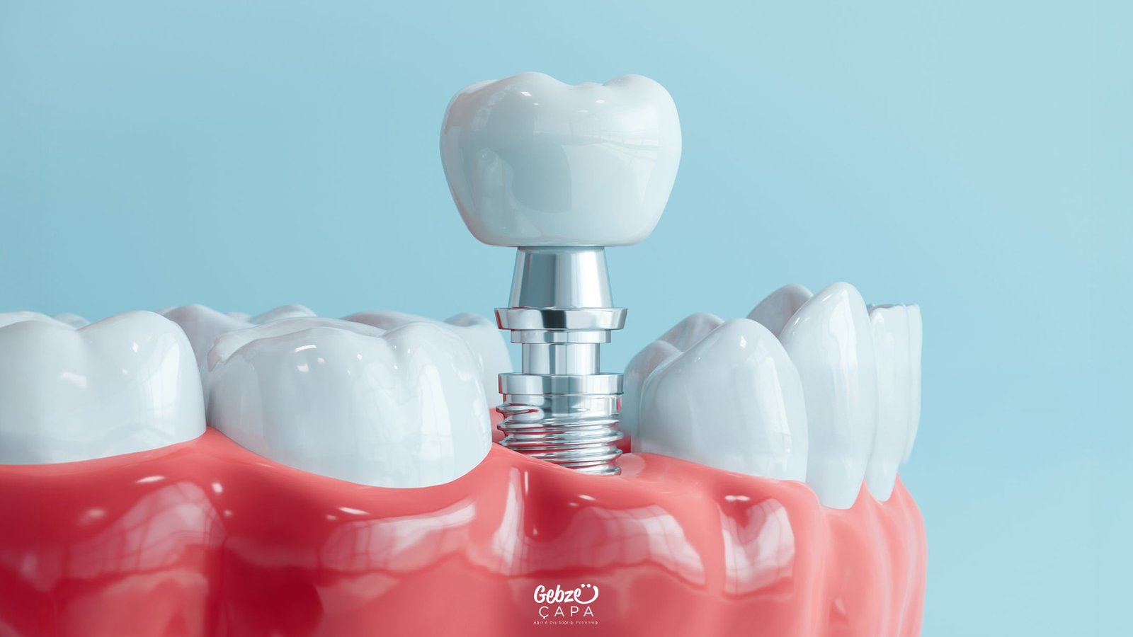 Gebze İmplant Tedavisi