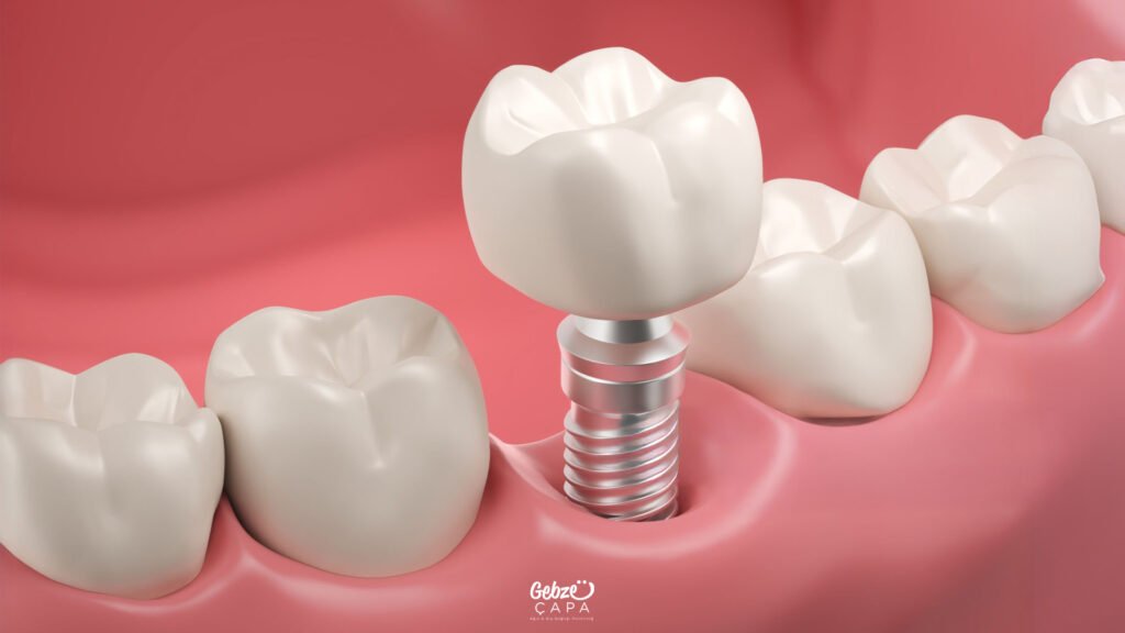 Gebze İmplant Tedavisi