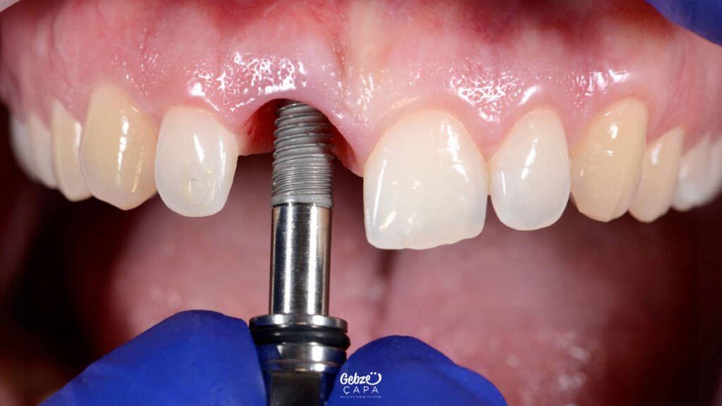 Gebze İmplant Tedavisi