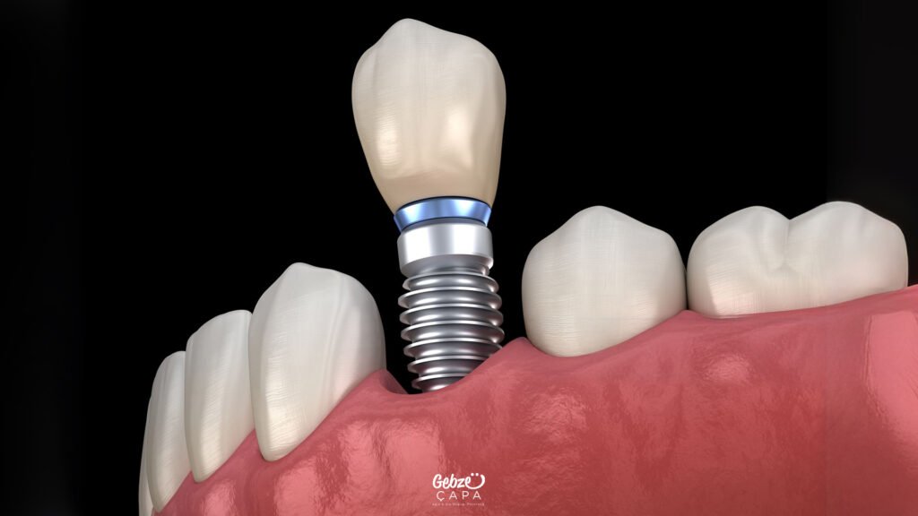 Gebze İmplant Tedavisi